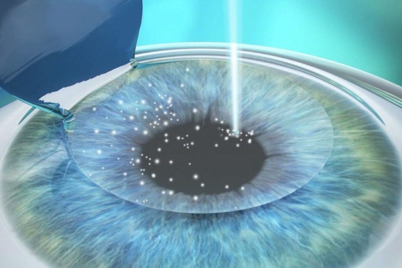 LASIK: 2. Generation des Augenlaserns