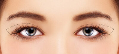 Oberlidstraffung (Blepharoplastik)